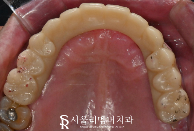 서울대입구역 치과 나에게 맞는 보철은 틀니? 임플란트? 관련 이미지 8