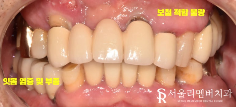 전에 씌워놨던 크라운에서 통증이 느껴져요.. 도대체 왜 그런 거죠? 서울대입구역 서울 리멤버 치과 관련 이미지 1