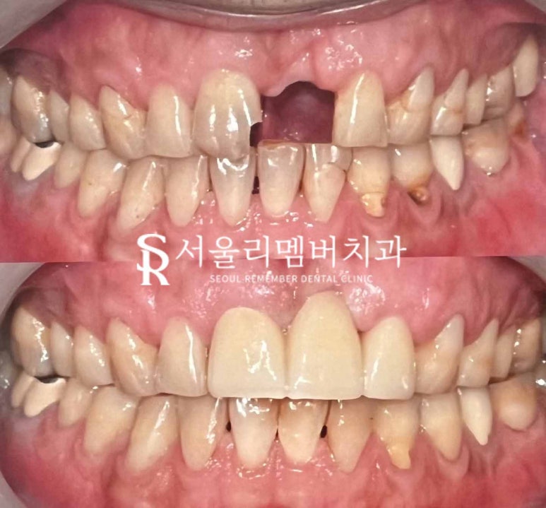 봉천동 치과 에서 신경치료 및 브릿지로 깨진 치아 회복하기 관련 이미지 5