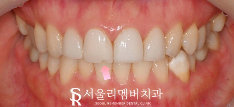 서울대입구역 치과, 깨진 앞니 라미네이트 한 개만 교체 치료 가능할까요? 관련 이미지 2