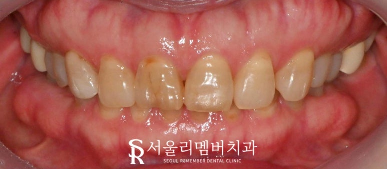 상도동 치과 누렇게 보이는 앞니 6전치 심미보철 라미 리얼네이트로 밝고 자연스럽게 개선한 사례 관련 이미지 3