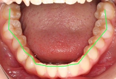 조기접촉 교정 전 관련 이미지 5