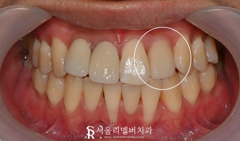 서울대입구 치과 앞니 심한 파절 및 신경치료 + 포스트 코어 + 지르코니아 심미 보철 크라운 진료 과정 관련 이미지 2