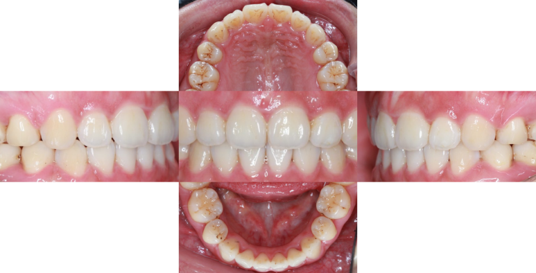 삐뚤어진 앞니 치료 후 관련 이미지 1