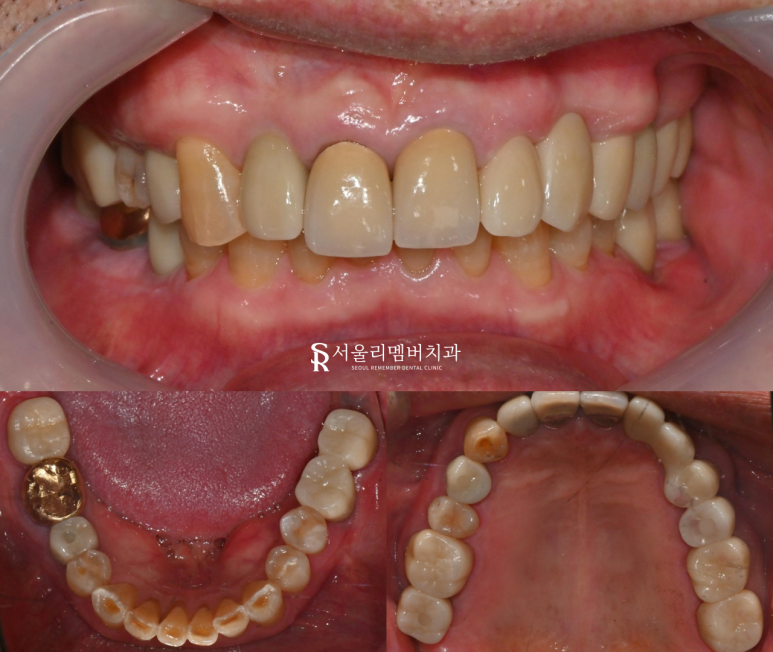 낙성대 치과 다수 상실된 치아 가이드 임플란트 식립으로 정확하고 튼튼한 치료 후기 관련 이미지 4