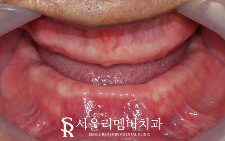 보라매 치과 에서 틀니에서 수면마취 전악 임플란트로 전체 치아 기능 회복 관련 이미지 1