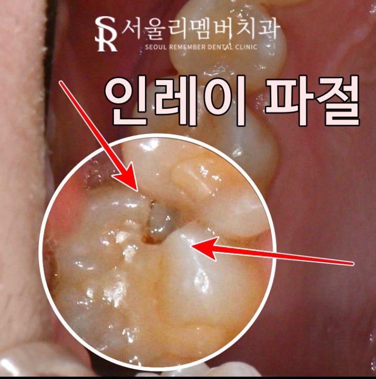봉천동 치과 인레이 했던 치아가 깨졌다면? 스트라우만 나이스 인레이 재치료 관련 이미지 1