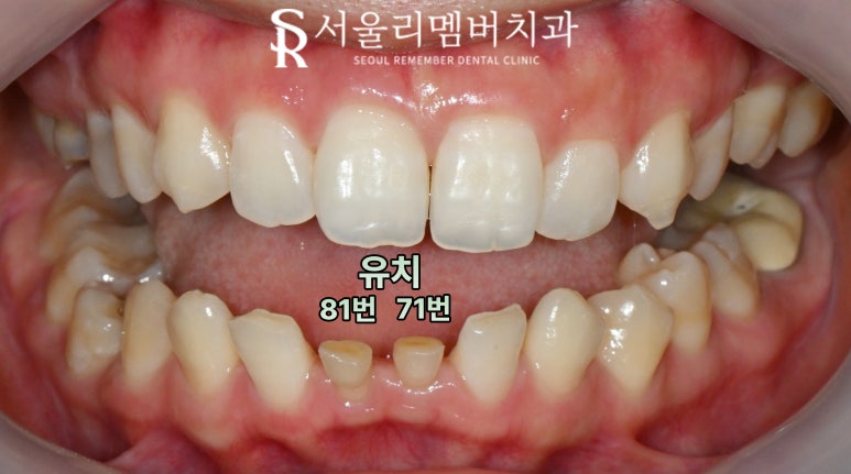 사당 치과 아래 앞니 만기 잔존 유치 크라운과 리얼네이트 동시에 심미 보철 치료 관련 이미지 3