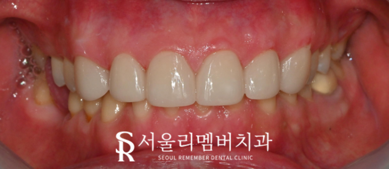앞니 치료, 이제는 자연스러움이 답이다! 봉천동 치과 진짜 같은 라미네이트 "리얼네이트" 관련 이미지 6