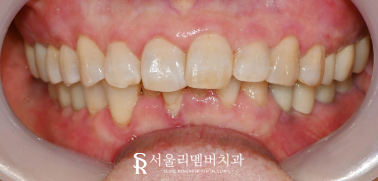 봉천동 치과 상실된 치아 방치하면 안 되는 이유 (feat.임플란트 브릿지 보철치료) 관련 이미지 7