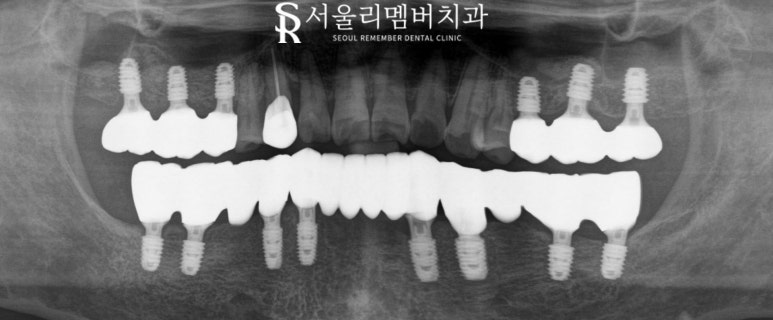 무너진 구강 환경 서울대입구역 치과 에서 편하게 전체 임플란트 치료한 사례 관련 이미지 7