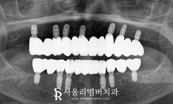 서울대입구역 치과 에서 수면(의식하진정)요법 동반한 전체 임플란트 식립 관련 이미지 5