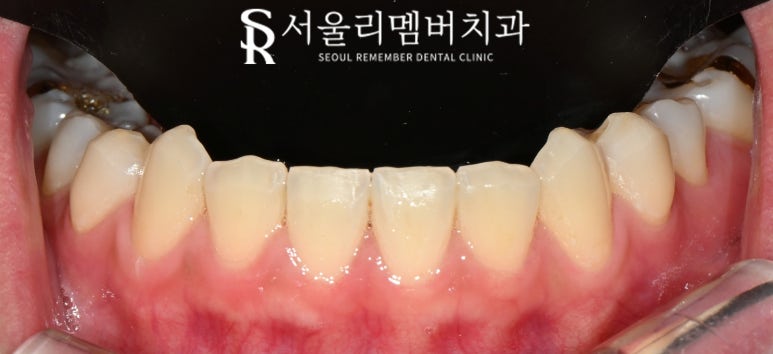 사당역 치과 리얼네이트 심미보철 라미네이트로 누렇고 약한 앞니부터 작은 어금니까지 변화 관련 이미지 4