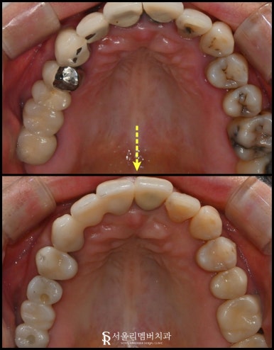 낙성대 치과 "어금니가 없어요." 가이드 임플란트와 신경치료 과정 관련 이미지 8