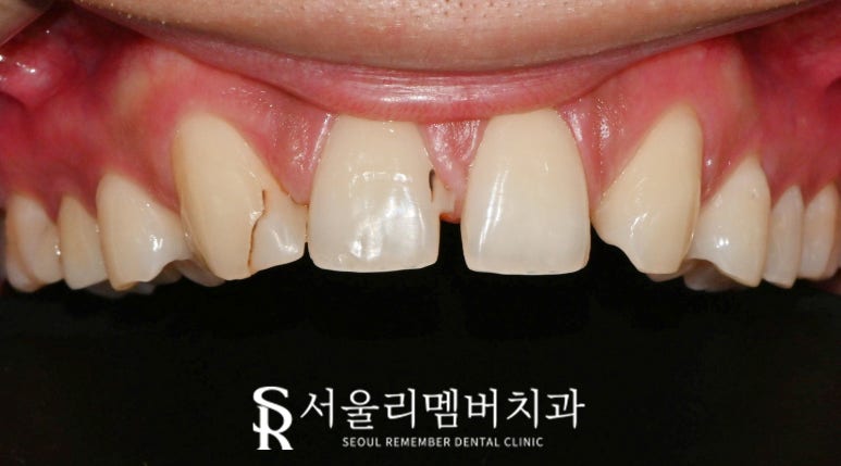 서울대입구 치과 결손된 앞니 자연스러운 라미 리얼네이트로 변색 레진과 사이 공간 막을 수 있다면 관련 이미지 3