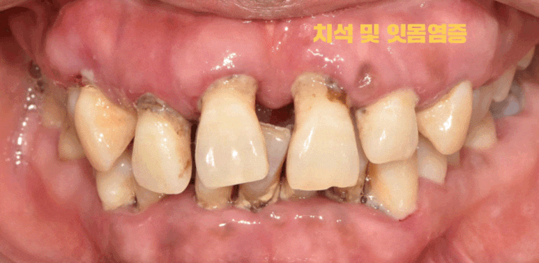 밝게 웃어본 적이 언젠지.. 낙성대역 서울 리멤버 치과 에서 잃어버린 미소를 찾아드렸습니다. 관련 이미지 1