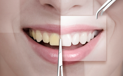 누런이가 고민이신가요? 신대방 치과 에서 전문가 치아 미백 과정 관련 이미지 1