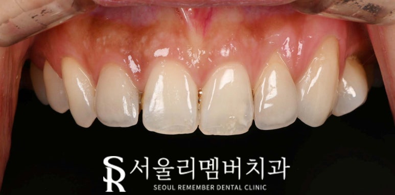 기존 라미네이트에 틈과 변색이 생겼다면? 낙성대 치과 상악 4전치 리얼네이트로 다시 완성한 앞니 관련 이미지 3