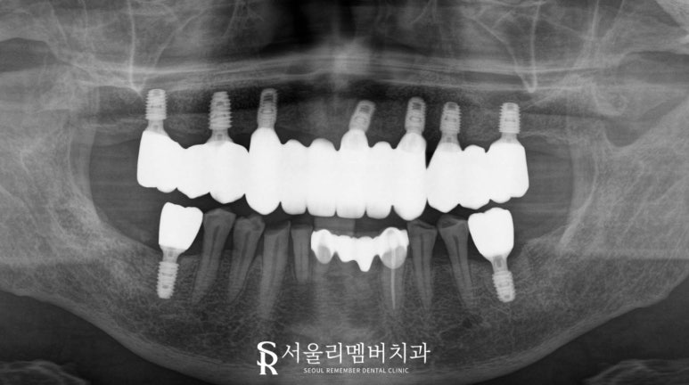서울대입구역 치과 치아가 하나도 없는 무치악 환자를 위한 최소 비용 풀아치 임플란트 관련 이미지 7