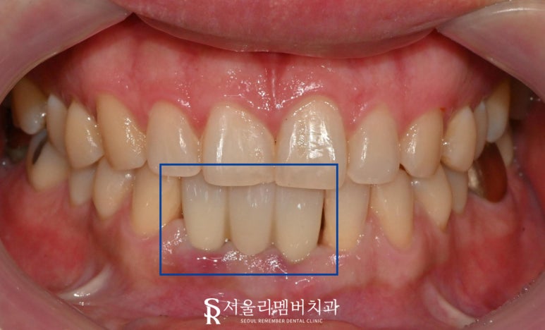 서울대입구 치과 아래 앞니 하악 전치부 브릿지에서 임플란트로 바꿀 수 있나요? 관련 이미지 3