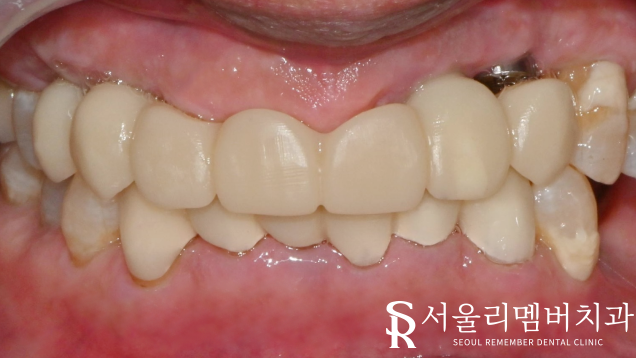 신림역 치과 임플란트 식립 시 어떤 것을 우선적으로 고려하는 것이 좋을까? 관련 이미지 4
