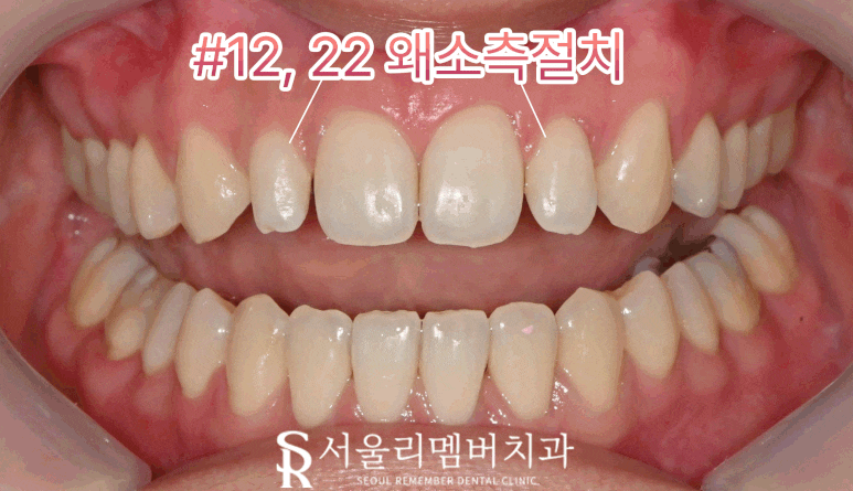 치아 크기 작은 왜소 측절치, 봉천동 치과 전치부 라미네이트로 자연치 삭제 없이 리얼하게 개선하는 방법 관련 이미지 1