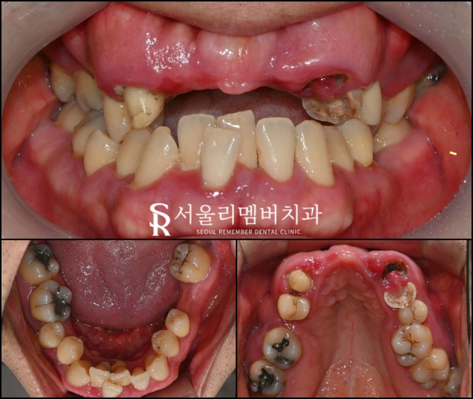 보라매 치과 무너지고 상실된 치아 반드시 신속한 임플란트 해야 됩니다. 관련 이미지 1