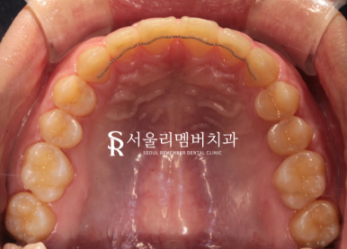 상도동치과 에서 발치 없이 깊게 물리는 과개교합 및 2급 부정교합 개선! 관련 이미지 9