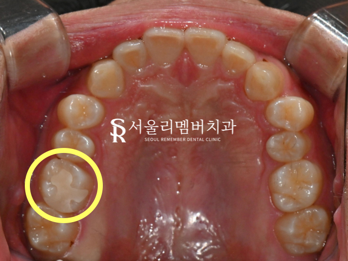 사당동 리멤버 치과 에서 어금니 이시림을 인레이로 개선해 드렸습니다. 관련 이미지 4