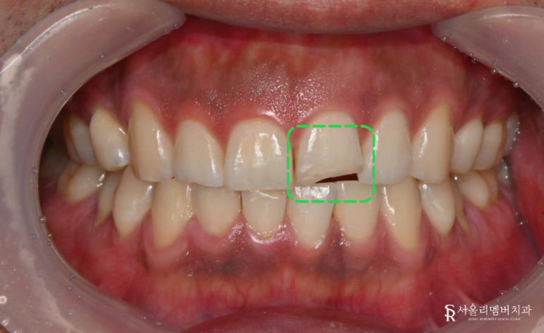When a Front Tooth Breaks: Bongcheon-dong Dental Clinic Explains Resin Treatment image 1