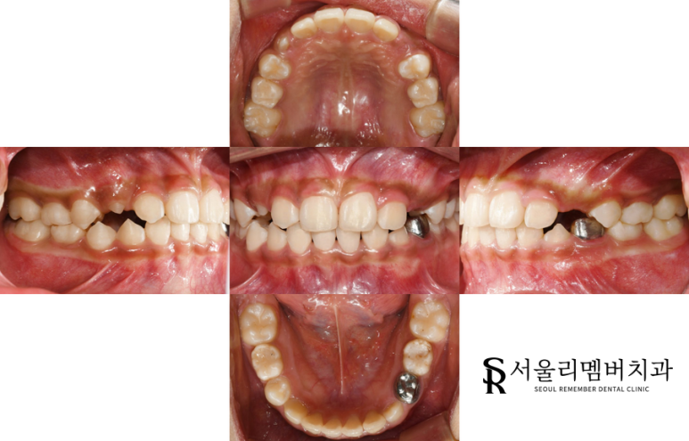과개교합 후 관련 이미지 1