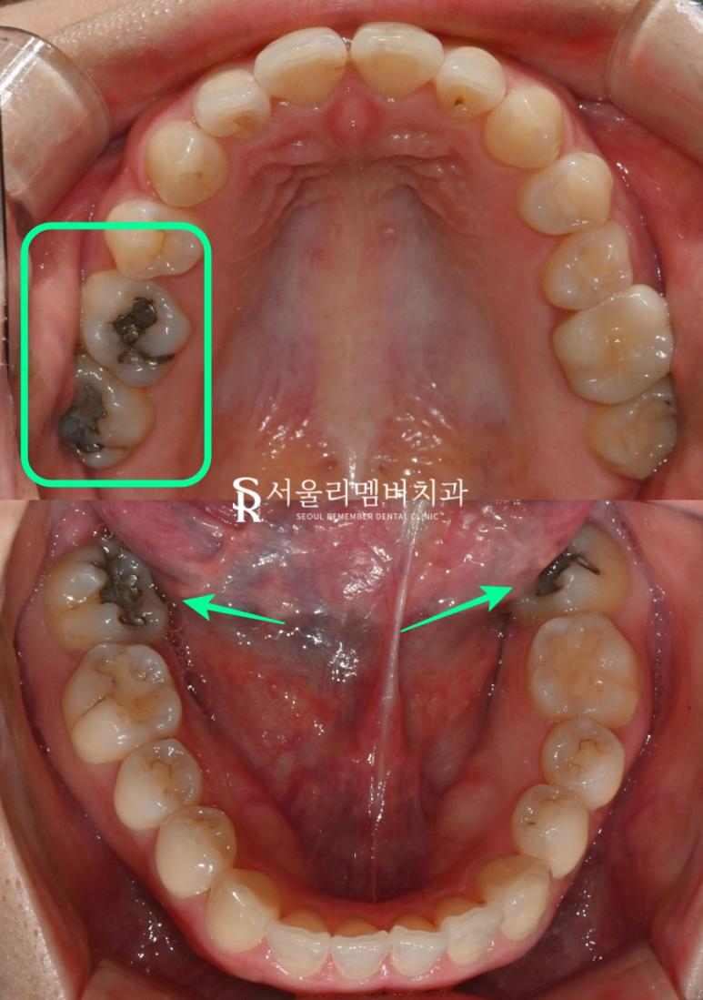 A “Pop-Out” Tooth, Cavities in the Front Teeth and Molars: Orthodontic and Cavity Treatment at a Sindae-bang Dental Clinic image 3