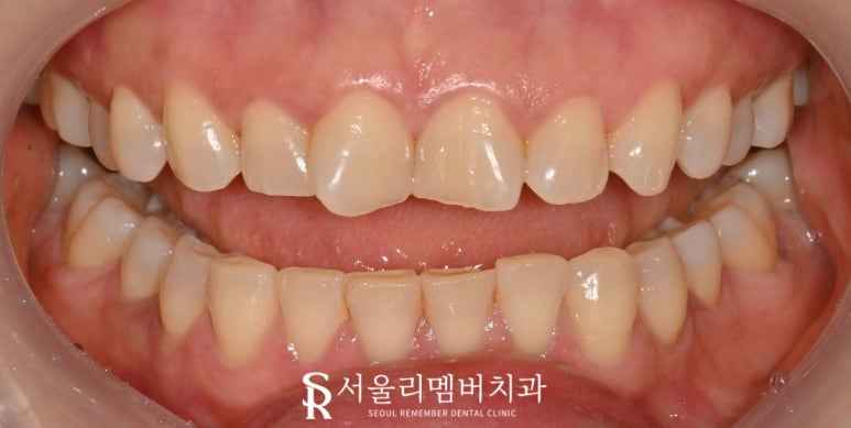 사당 치과 틀어지고 뻐드러진 앞니, 송곳니까지 리얼네이트 치료로 자연스러운 전치부 균형 찾기 관련 이미지 1