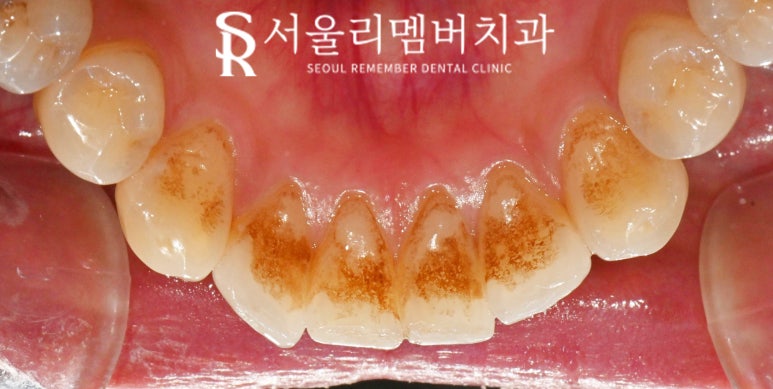15분이면 신림 치과 스케일링 착색 제거로 까맣고 누런 치석 없앨 수 있습니다. 관련 이미지 3