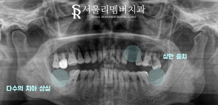 '임플란트 식립 시 뼈이식이 꼭 필요한 상황은?' 서울대입구역치과 관련 이미지 1