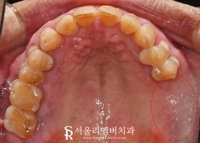 잃어버린 치아, 봉천동 치과 임플란트로 되찾는 자연스러운 미소와 건강한 저작 기능 관련 이미지 1
