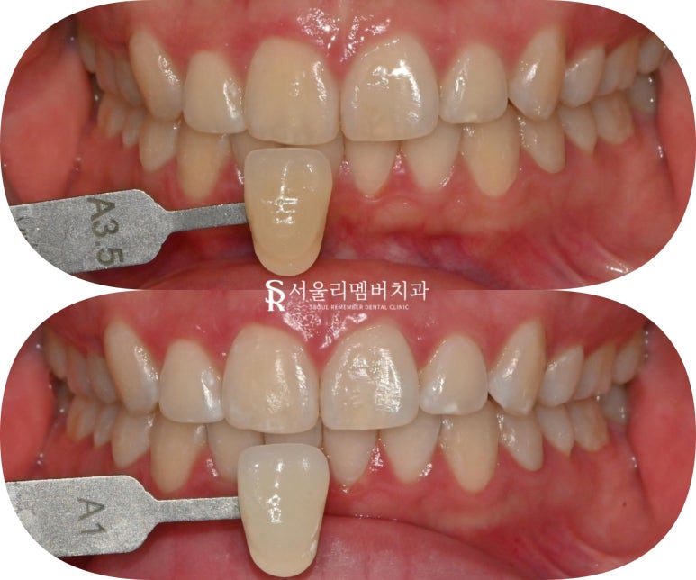 신림 치과 원데이 치아미백 (feat. 쿠*, 올*브영 아닌 식약처 등록된 안전한 전문가용 약제 사용) 관련 이미지 4