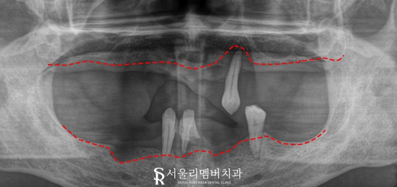 신대방 치과 에서 전악 수면마취 임플란트 수술로 전체 치아 회복시켜드렸습니다. 관련 이미지 5