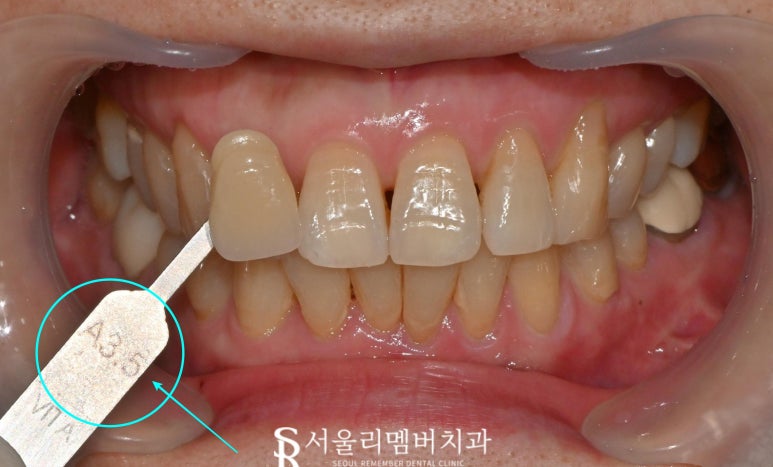 누런이가 고민이신가요? 신대방 치과 에서 전문가 치아 미백 과정 관련 이미지 2