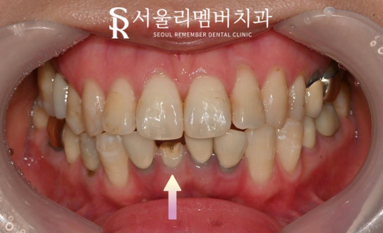 아래 앞니 부러짐 뿌리 끝 염증 봉천동 치과 하악 4전치 발치 후 오스템 임플란트 관련 이미지 2