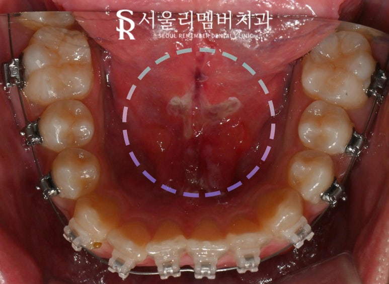 혀가 짧다? 설소대 절제술로 해결할 수 있습니다. 봉천동 치과 관련 이미지 4