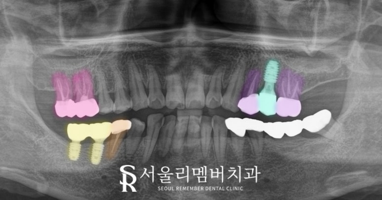 봉천역 치과 어금니 보철 후 음식물 끼임 및 치아 파절, 신경치료 크라운 및 임플란트 관련 이미지 9