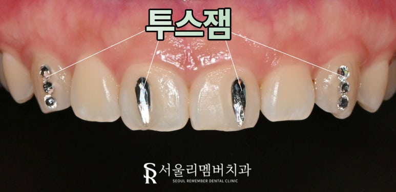 투스잼 제거, 전문가에게 맡겨야 하는 이유 신림역 치과 원하는 치아만 선택적으로 없앨 수 있을까? 관련 이미지 2