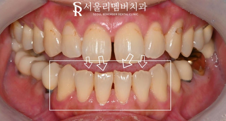 Improving Spaces Between the Front Teeth and Dark Staining from Discolored Resin at the Same Time: Anterior Laminate Veneers and Realnate at Seoul National University Entrance Station Dental Clinic image 2