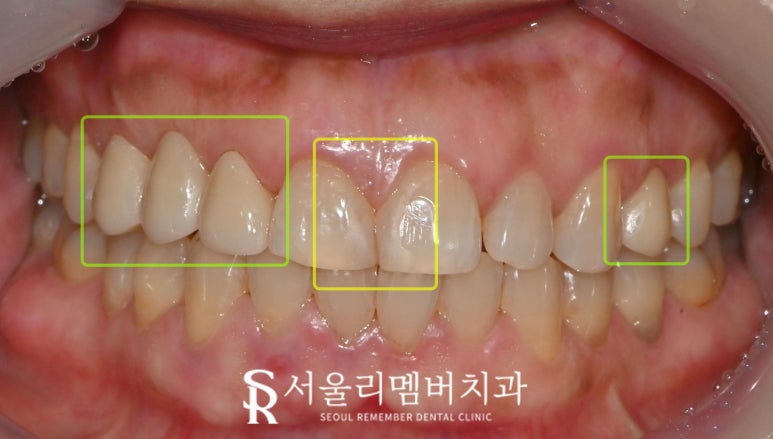 서울대입구 치과 에서 앞니 벌어짐, 변색, 부러지고 통증 있는 치아 레진과 크라운으로 심미 치료 해드린 사례 관련 이미지 3