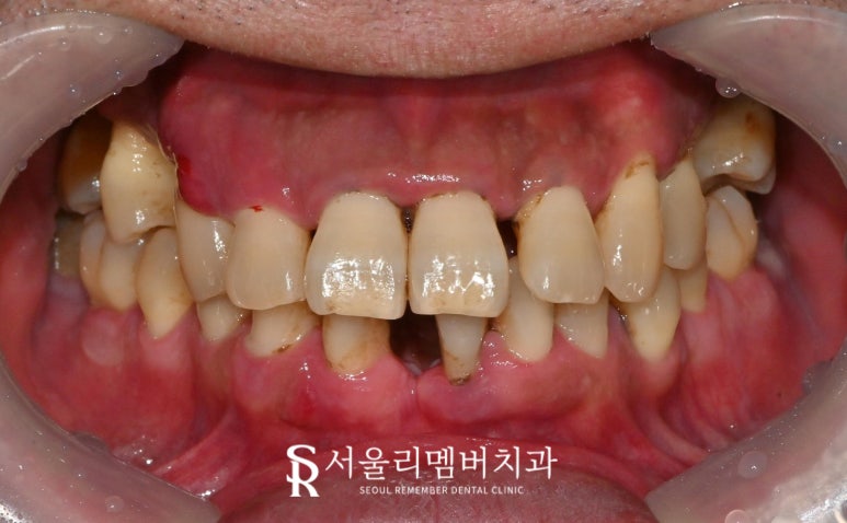치아 빠지고 흔들리는 어금니와 치주 질환으로 통증 생긴 구강, 관악구 치과 상악 전체 임플란트 및 하악 신경치료 크라운 진행 과정 관련 이미지 2