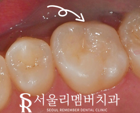 봉천역 치과 어금니 깨짐 당일 레진 치료 되는 곳, 자연스러운 외관 회복 관련 이미지 3