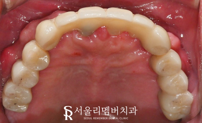 치아가 없을 땐? 서울대입구역 치과 에서 부기 통증 없는 최소절개 전체 디지털 임플란트 치료 관련 이미지 7