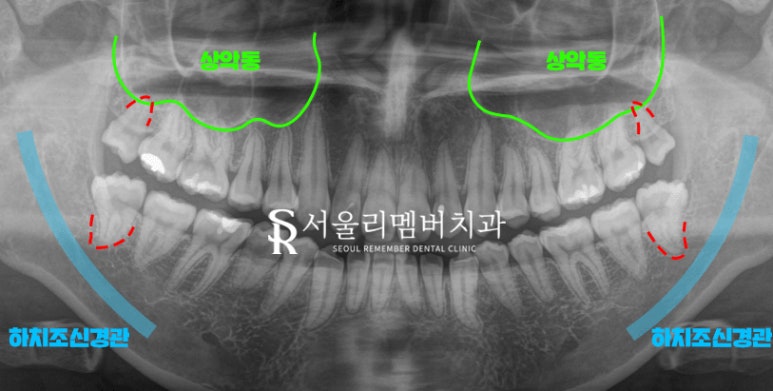 사당역 치과 사랑니 발치 시 이곳을 조심해야 됩니다! (하치조신경/상악동) 관련 이미지 2