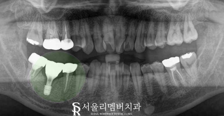 치아 깨지고 통증 있을 때, 서울대입구역 치과 파절 정도에 따른 신경치료 크라운 및 발치 임플란트 관련 이미지 6